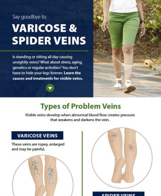 Varicose Spider Veins