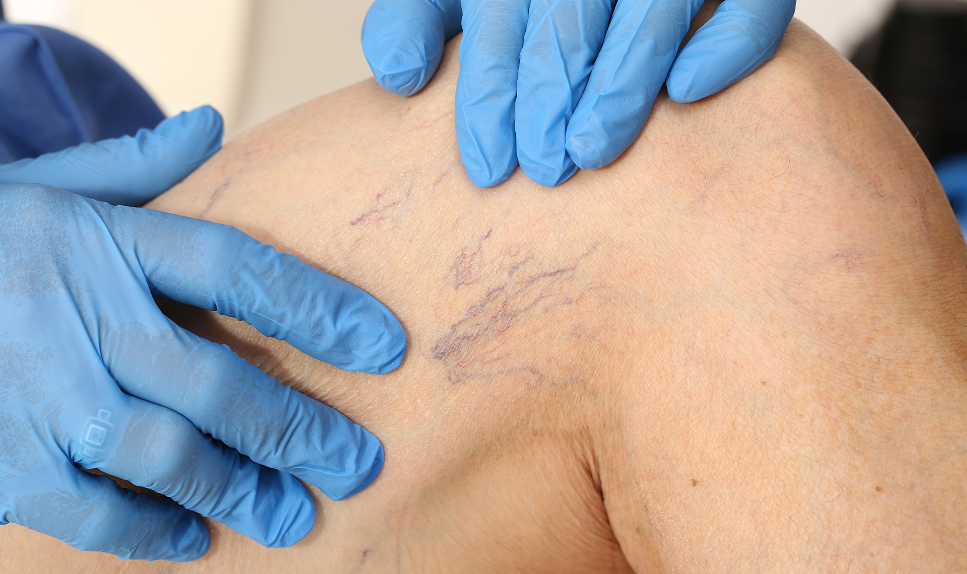 Spider Vein Causes And Treatments Charlotte Radiology